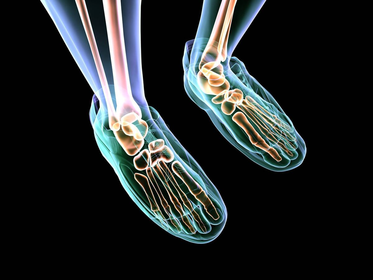 Osteoarthritis (OA) is characterised by a progressive loss of articular cartilage, t space narrowing and osteophyte formation. Picture: Stock Osteoarthritis (OA) is characterised by a progressive loss of articular cartilage, t space narrowing and osteophyte formation. Picture: Stock